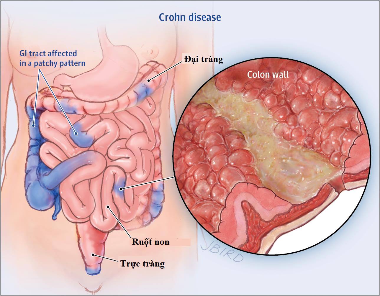 Liệu pháp mới trong điều trị bệnh Crohn