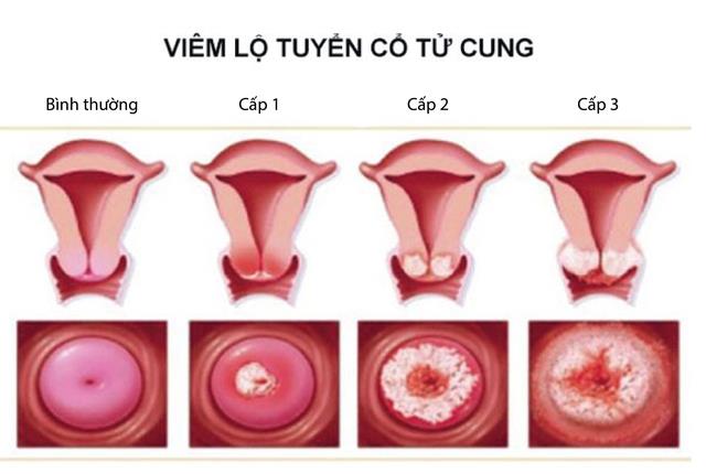 Tắc vòi trứng gây vô sinh ở phụ nữ?