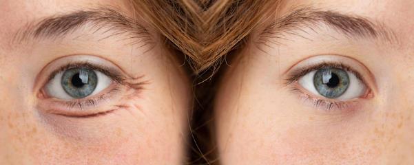 5 cách khắc phục quầng thâm dưới mắt hiệu quả tại nhà