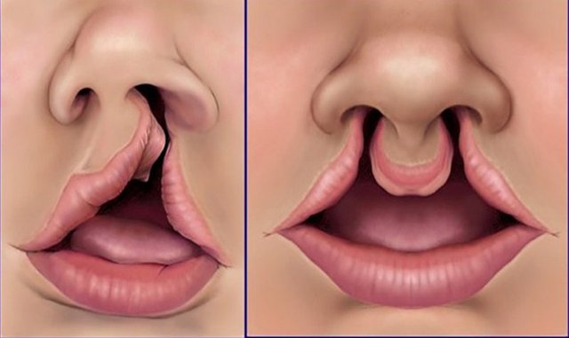 Những vấn đề thường gặp khi chăm sóc trẻ dị tật khe hở môi - vòm miệng