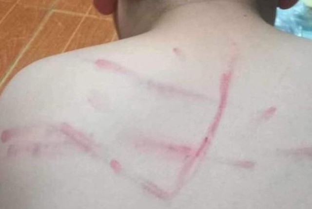 Không làm bài tập, một học sinh lớp 4 bị cô giáo đánh bầm tím lưng