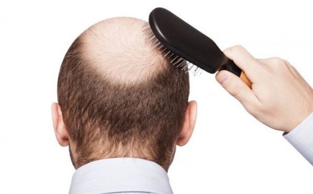 Phối hợp thuốc điều trị hiệu quả chứng rụng tóc từng mảng