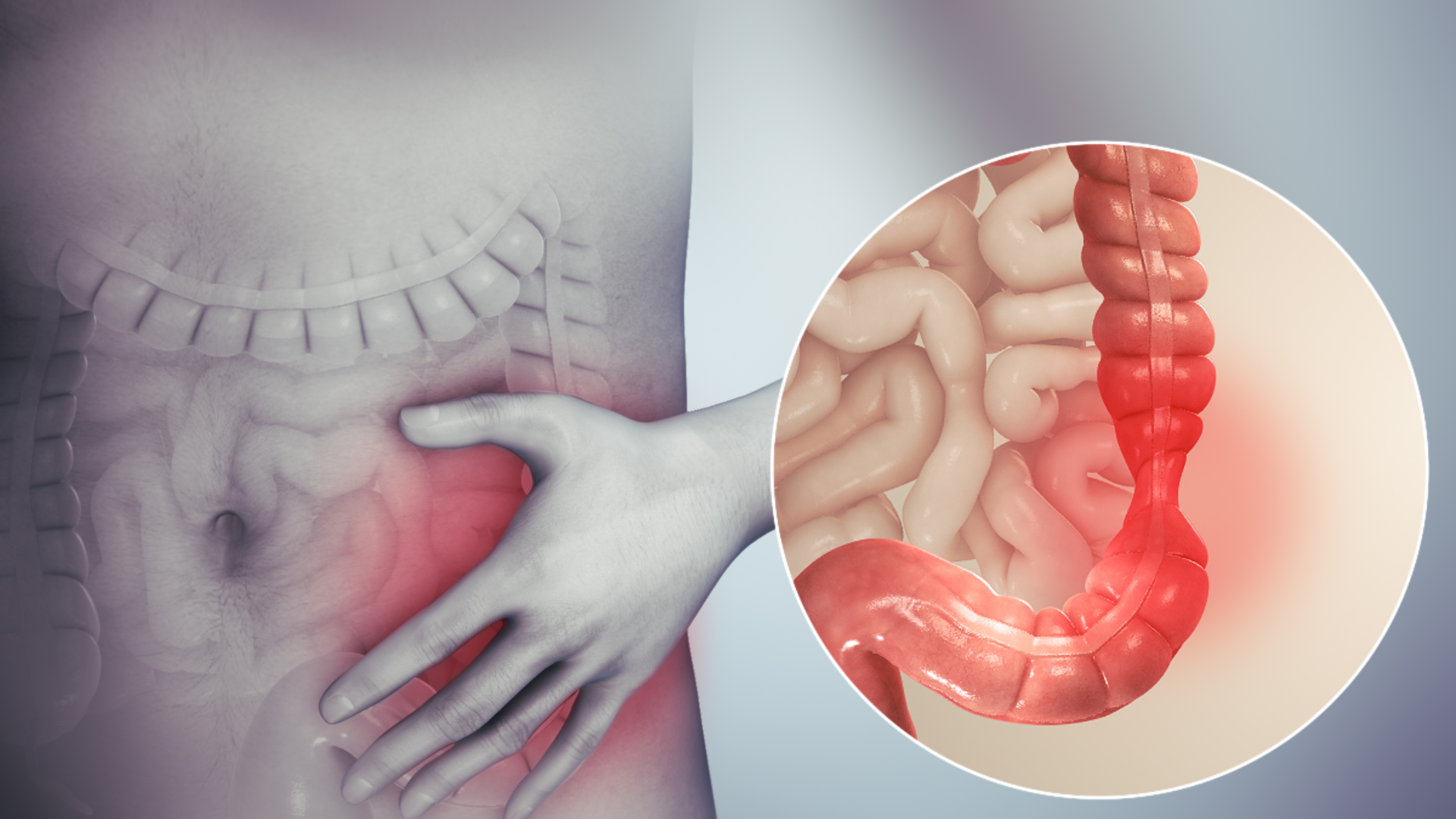 Người mắc hội chứng ruột kích thích có nên bổ sung men vi sinh?