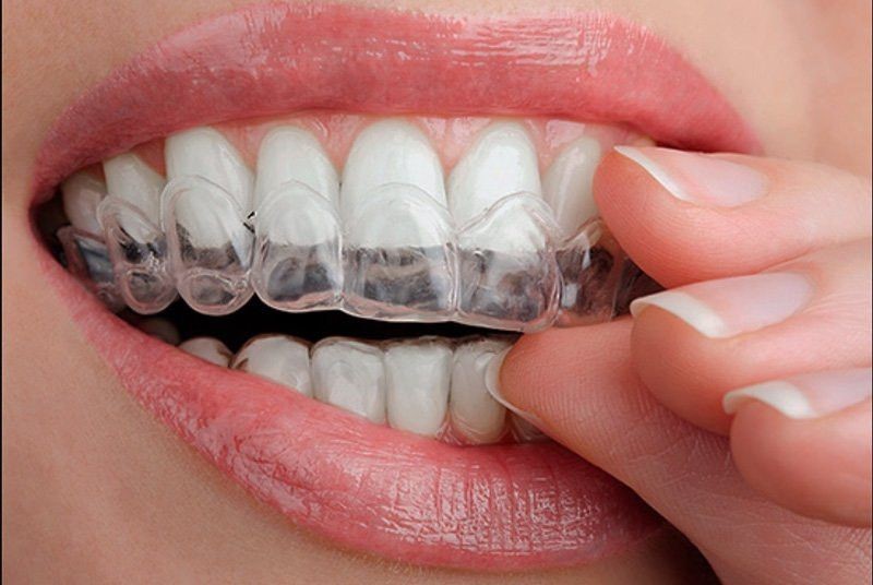 Tẩy trắng răng có làm hại men răng không?