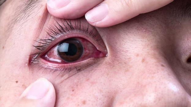 Đau mắt đỏ nhỏ thuốc gì?