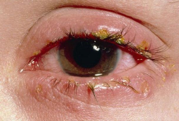 4 bài thuốc giảm triệu chứng khó chịu do đau mắt đỏ