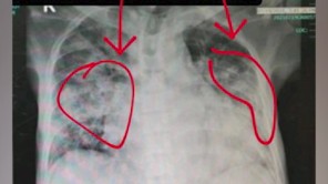 Rùng mình với lá phổi đông cứng do chưa tiêm phòng COVID-19?