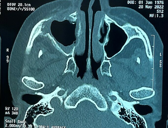 Các triệu chứng thường gặp ở người bệnh hoại tử xương sọ mặt hậu Covid-19