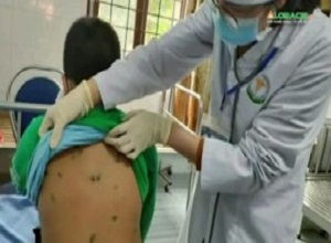 Hai loại bệnh truyền nhiễm tấn công nhiều trẻ em Hà Nội và các tỉnh phía Bắc